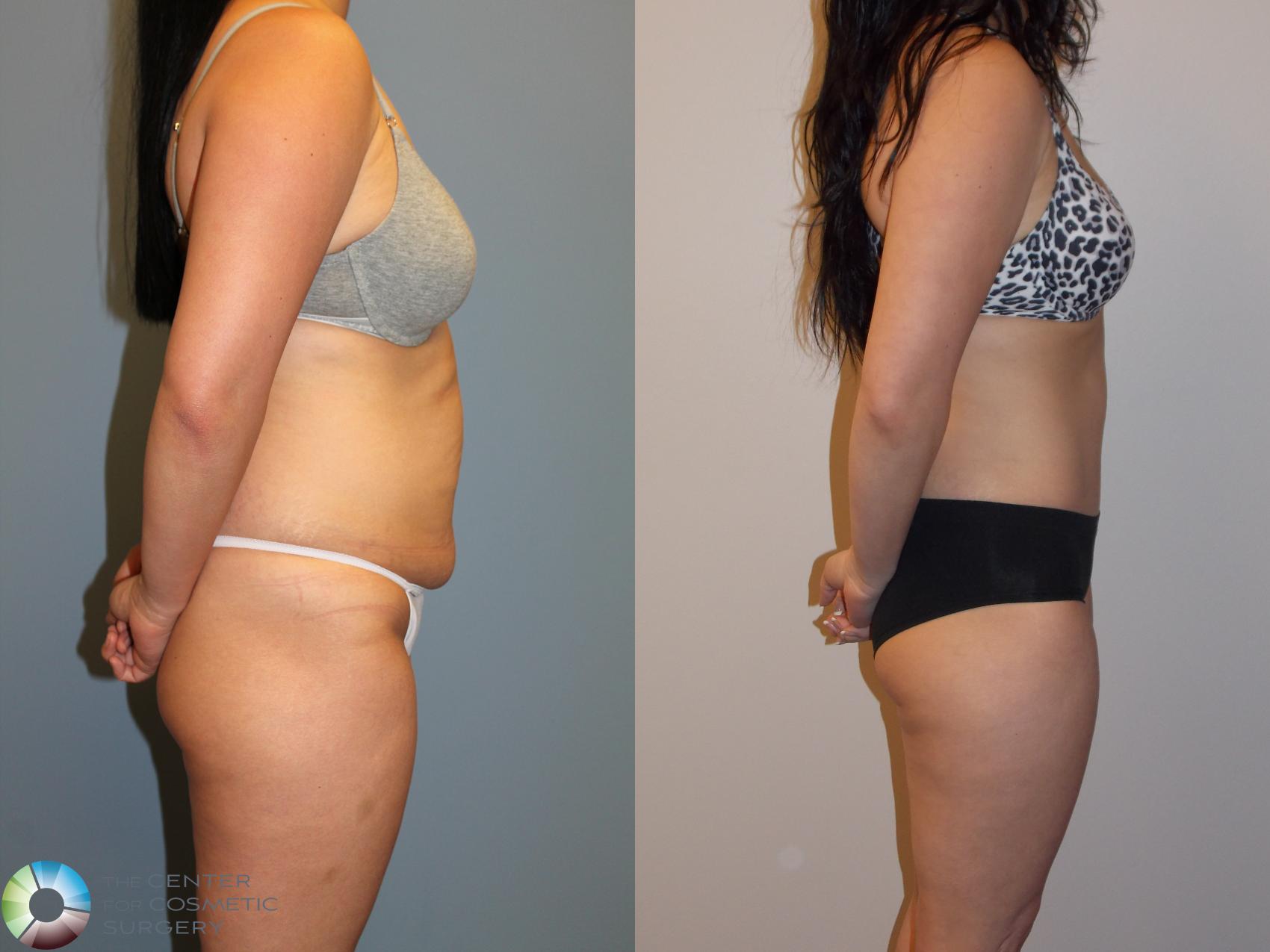 Before & After Tummy Tuck Case 11538 Right Side View in Golden, CO