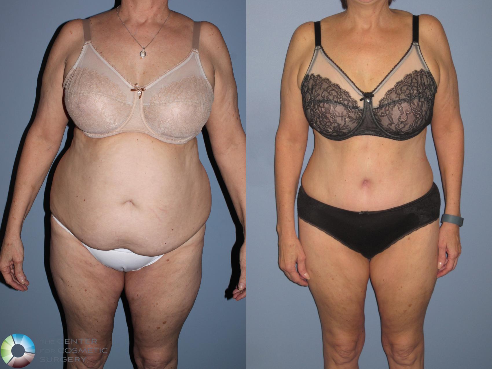 Before & After Tummy Tuck Case 11539 Front View in Golden, CO