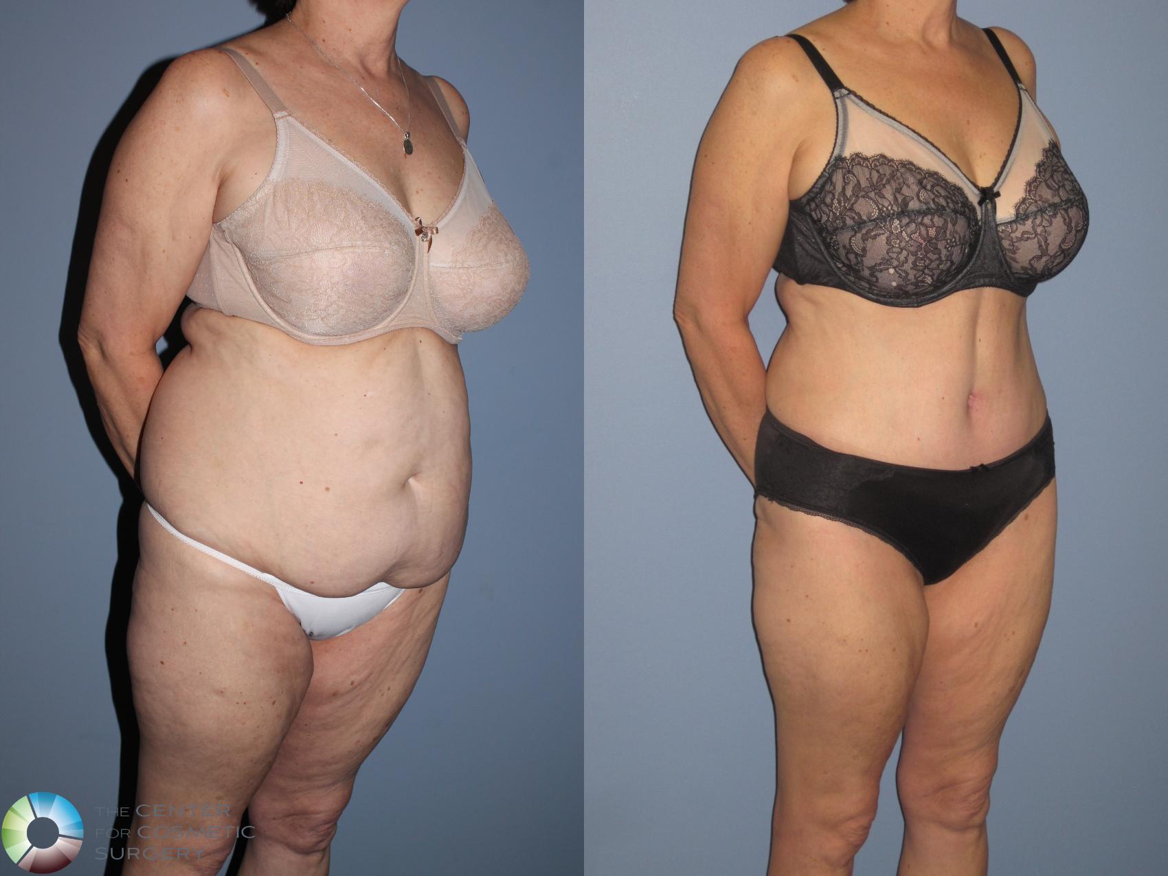 Before & After Tummy Tuck Case 11539 Right Oblique in Denver and Colorado Springs, CO