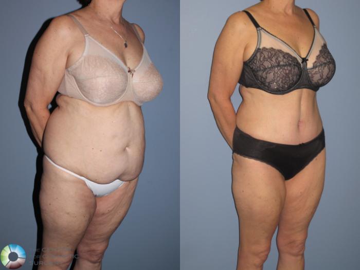Before & After Tummy Tuck Case 11539 Right Oblique View in Golden, CO