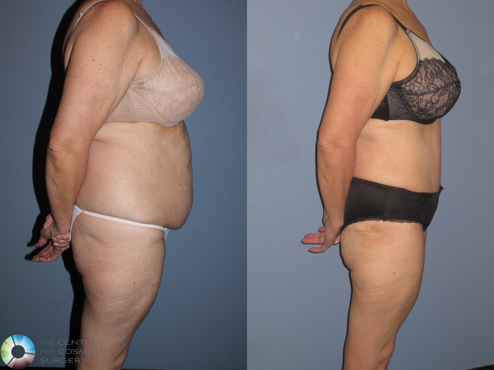 Before & After Tummy Tuck Case 11539 Right Side in Denver and Colorado Springs, CO