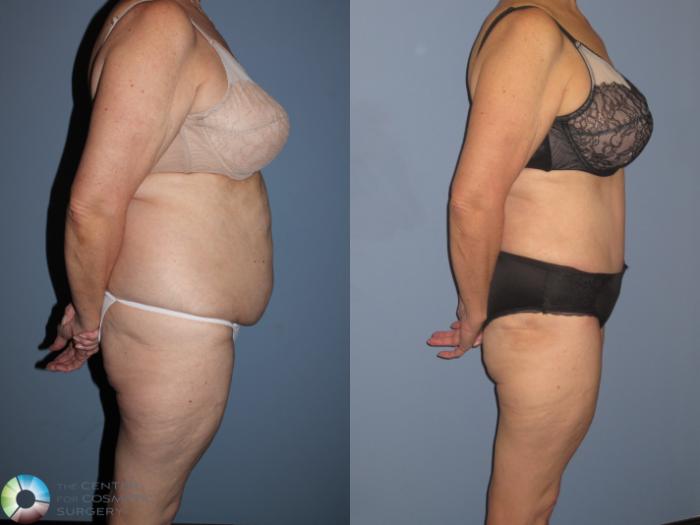 Before & After Tummy Tuck Case 11539 Right Side View in Golden, CO