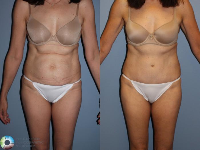 Before & After Tummy Tuck Case 11581 Front in Denver and Colorado Springs, CO