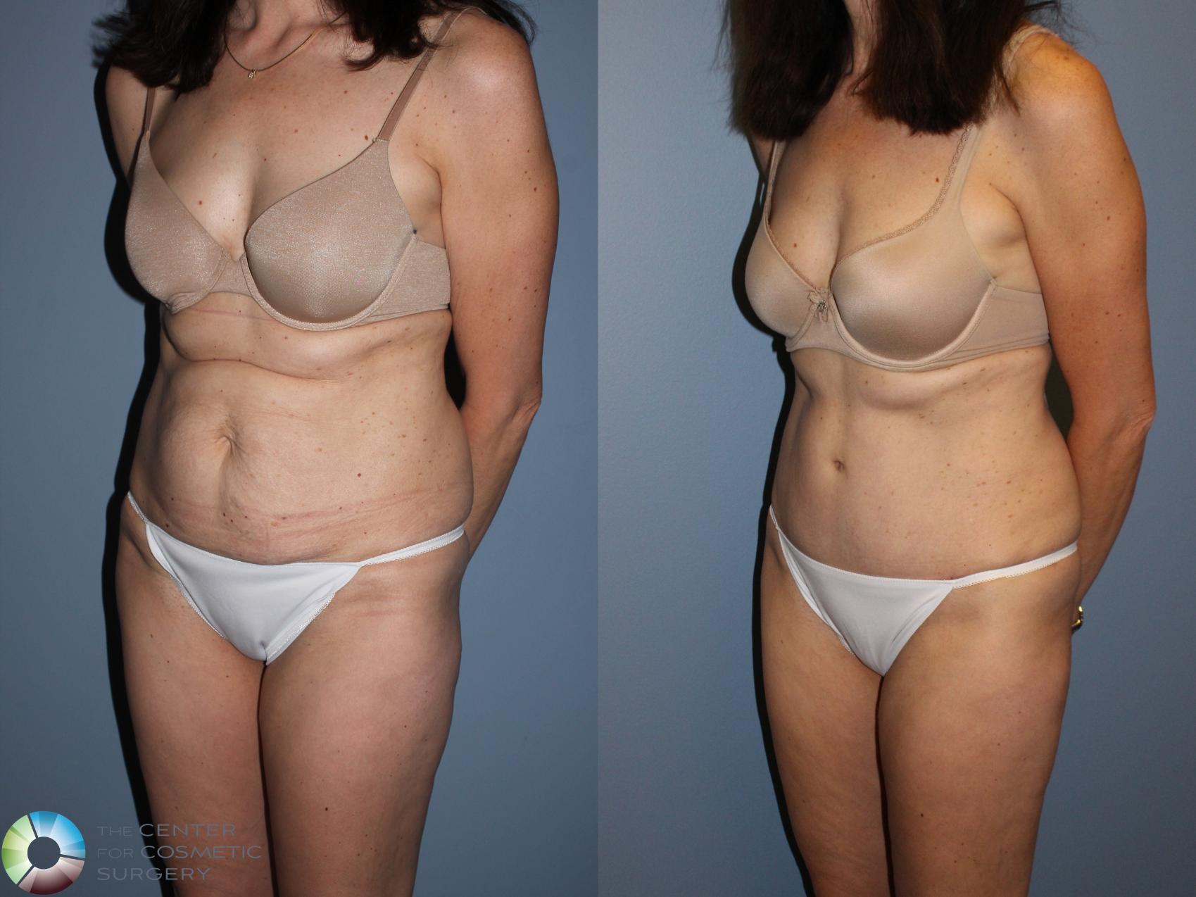 Before & After Tummy Tuck Case 11581 Left Oblique View in Golden, CO