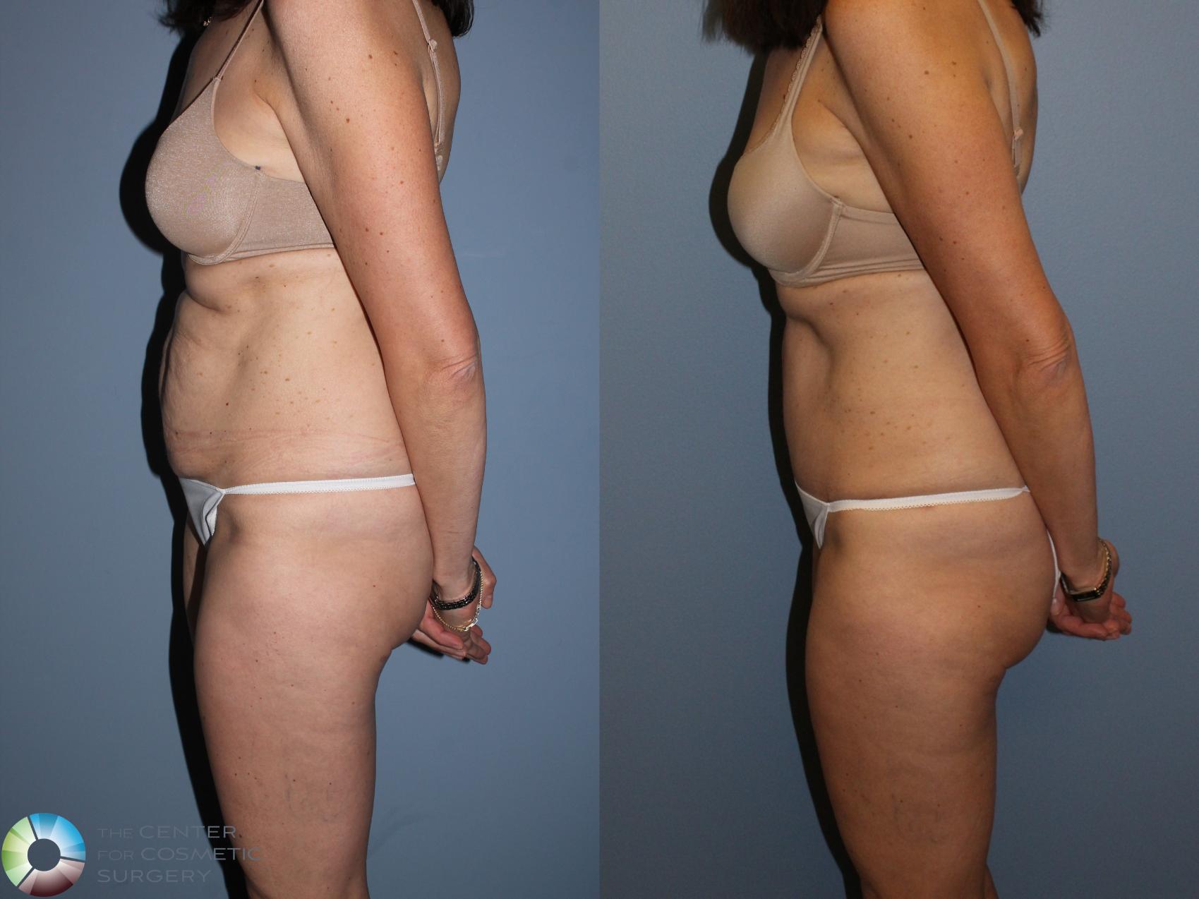 Before & After Tummy Tuck Case 11581 Left Side View in Golden, CO