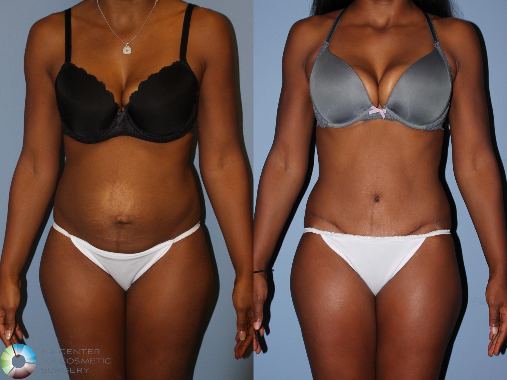 Before & After Tummy Tuck Case 11597 Front in Denver and Colorado Springs, CO