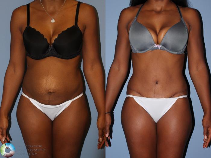 Before & After Tummy Tuck Case 11597 Front View in Golden, CO