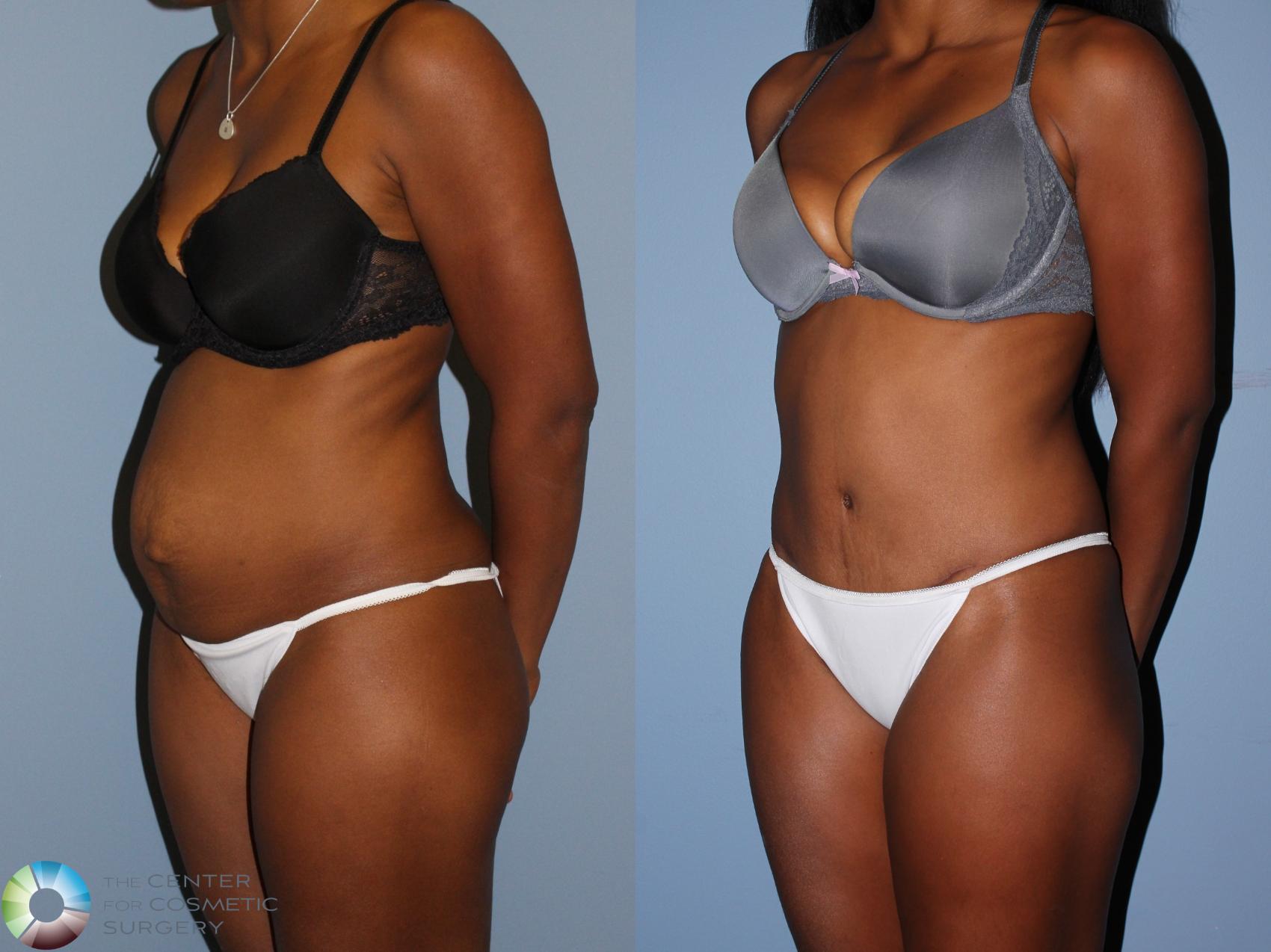 Before & After Tummy Tuck Case 11597 Left Oblique in Denver and Colorado Springs, CO