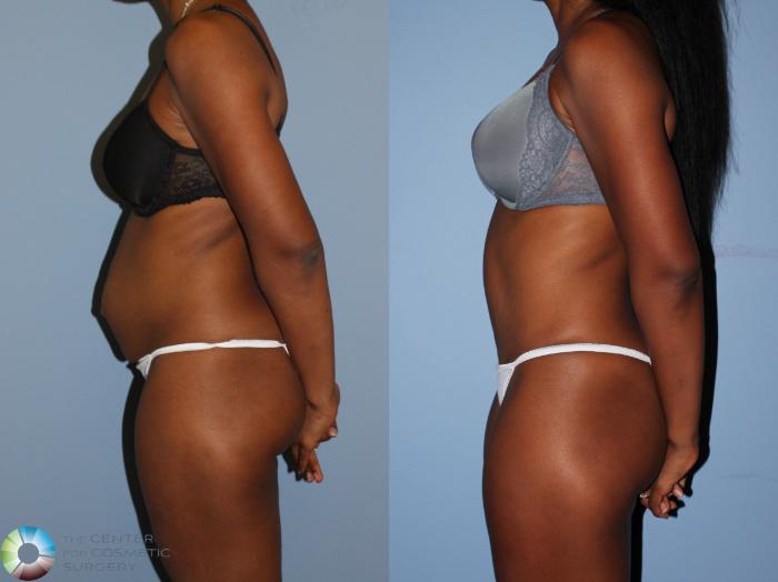 Before & After Tummy Tuck Case 11597 Left Side View in Golden, CO