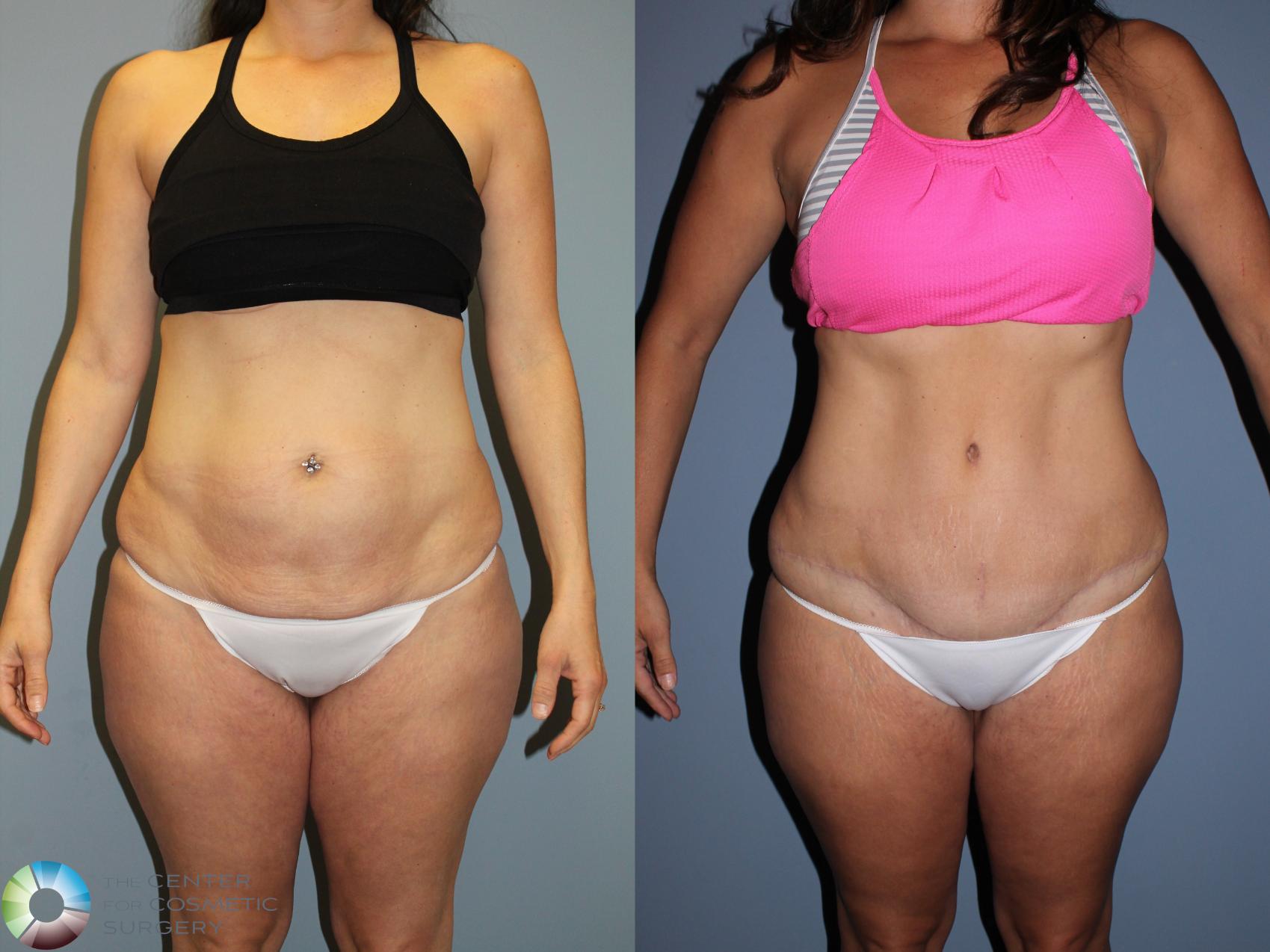 Before & After Tummy Tuck Case 11605 Front View in Golden, CO