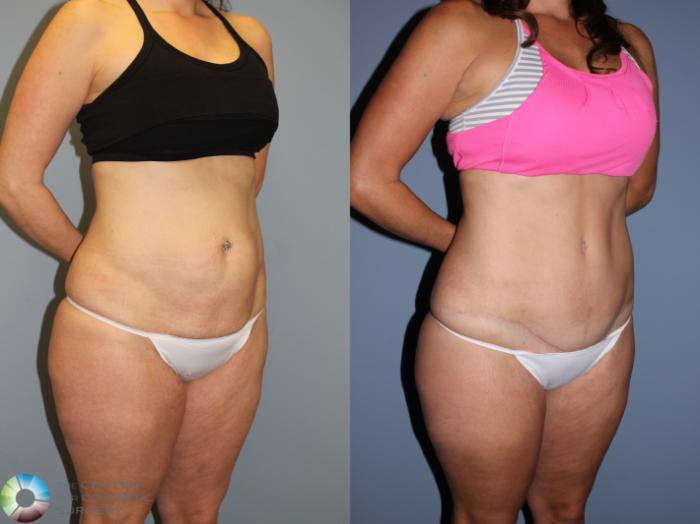 Before & After Tummy Tuck Case 11605 Right Oblique View in Golden, CO