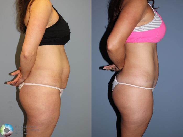 Before & After Tummy Tuck Case 11605 Right Side View in Golden, CO