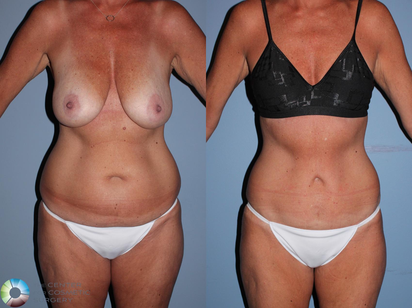 Before & After Tummy Tuck Case 11606 Front View in Golden, CO