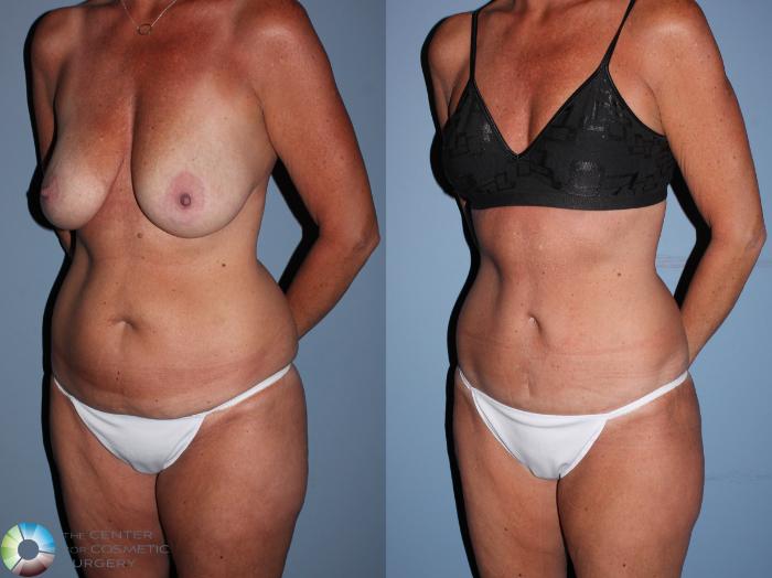 Before & After Tummy Tuck Case 11606 Left Oblique View in Golden, CO