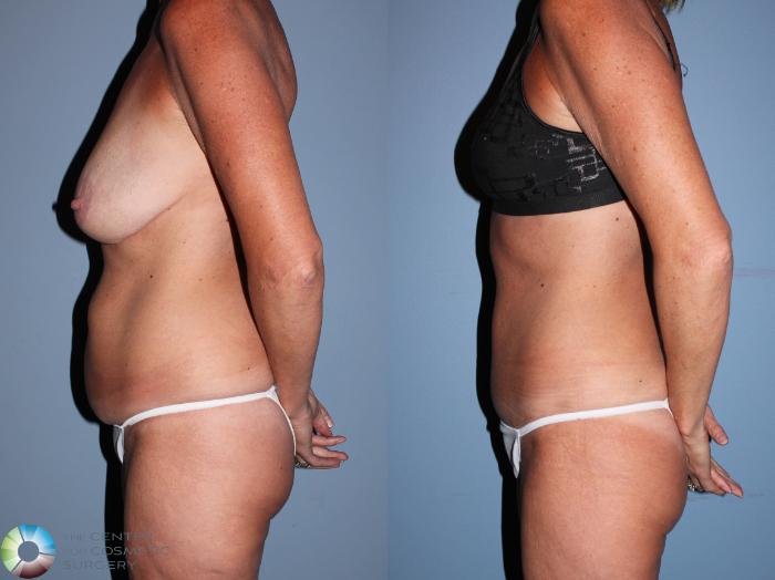 Before & After Tummy Tuck Case 11606 Left Side View in Golden, CO
