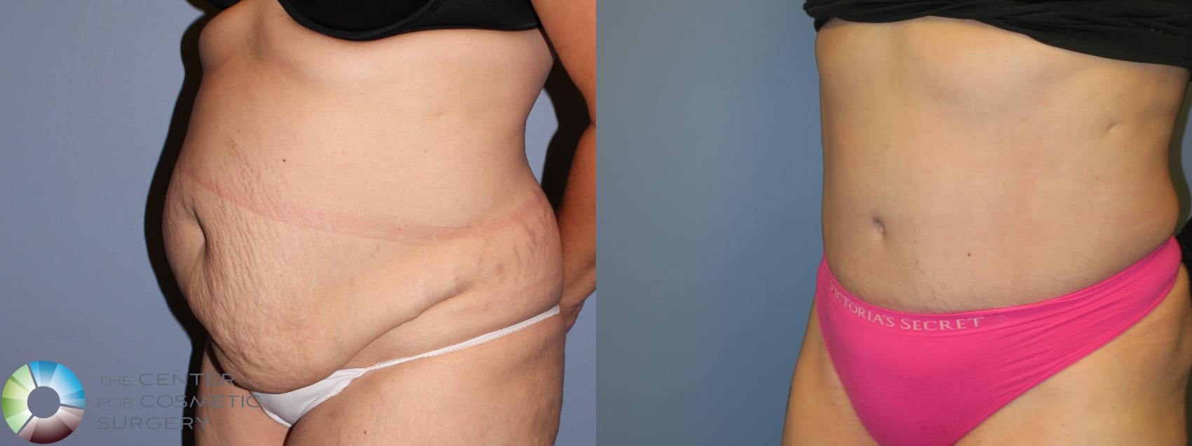 Before & After Tummy Tuck Case 11624 Left Oblique in Denver and Colorado Springs, CO