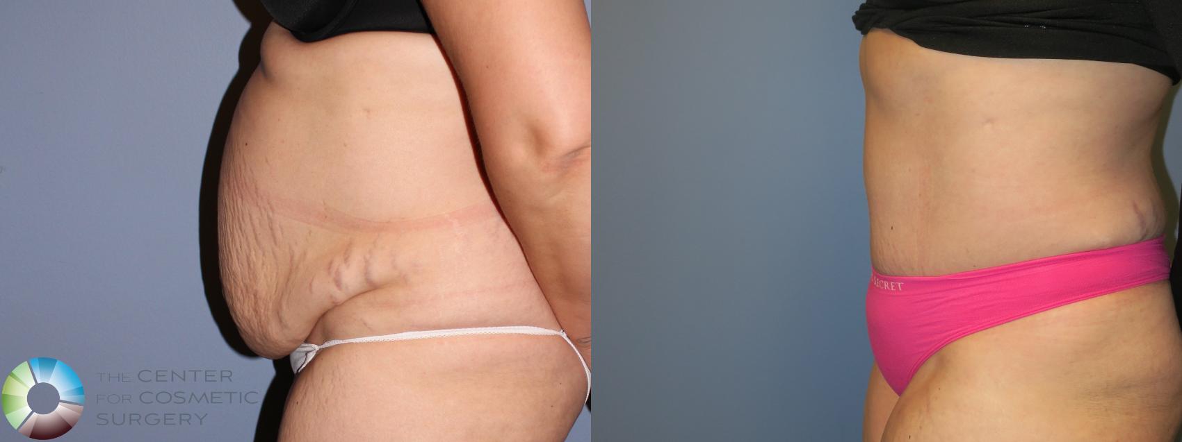 Before & After Tummy Tuck Case 11624 Left Side in Denver and Colorado Springs, CO