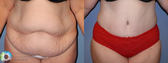 Before & After Tummy Tuck Case 11687 Front View in Golden, CO