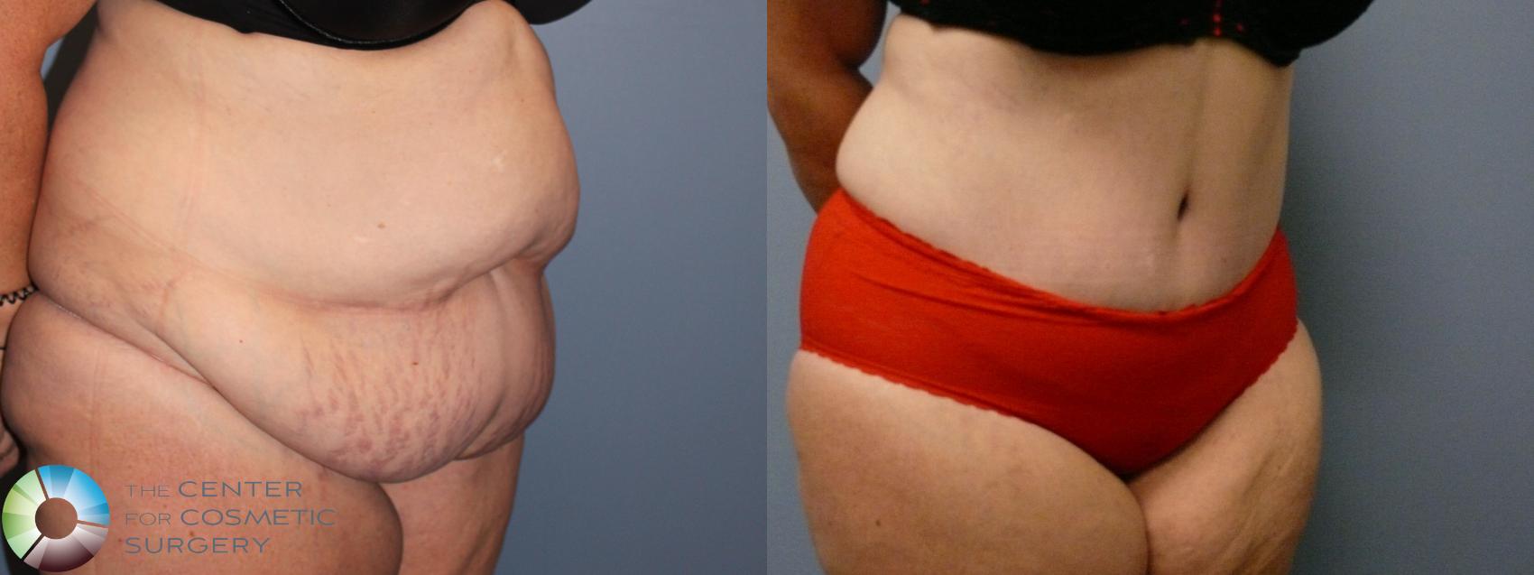 Before & After Tummy Tuck Case 11687 Right Oblique View in Golden, CO