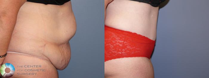 Before & After Tummy Tuck Case 11687 Right Side View in Golden, CO
