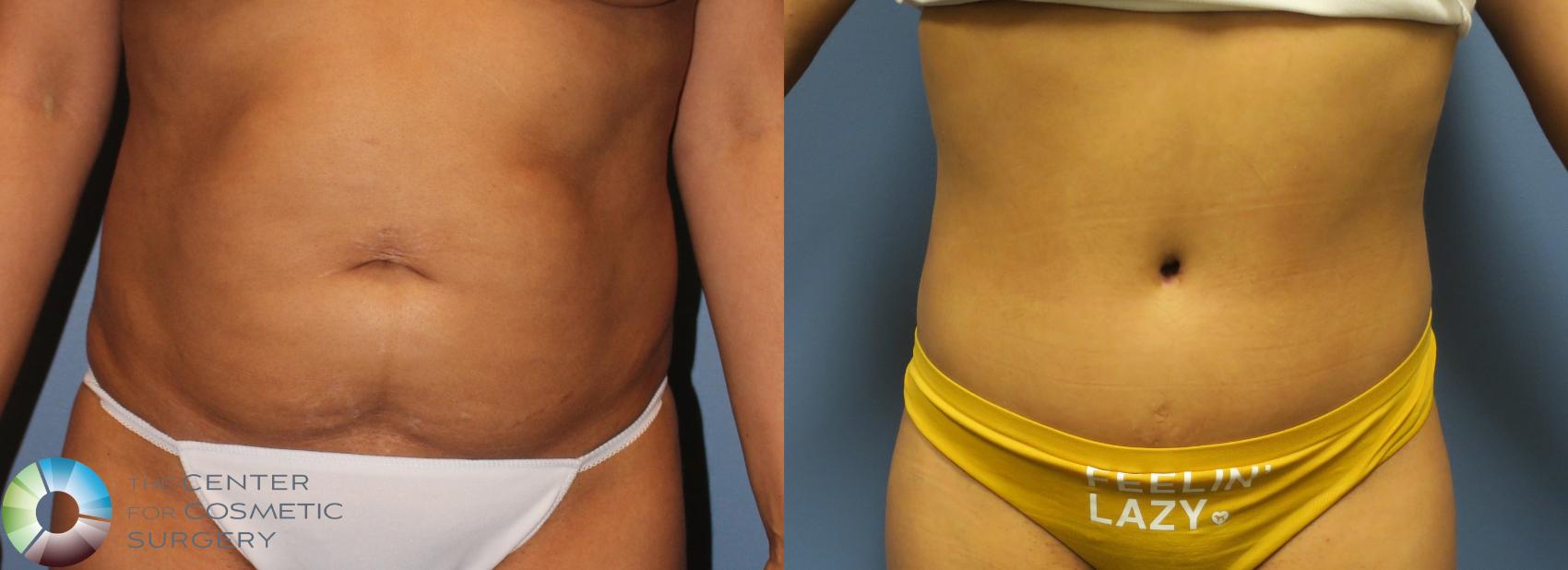 Before & After Tummy Tuck Case 11690 Front View in Golden, CO