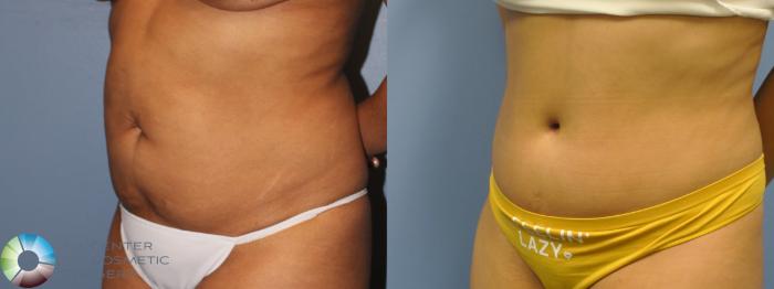 Before & After Tummy Tuck Case 11690 Left Oblique View in Golden, CO