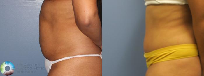 Before & After Tummy Tuck Case 11690 Left Side View in Golden, CO
