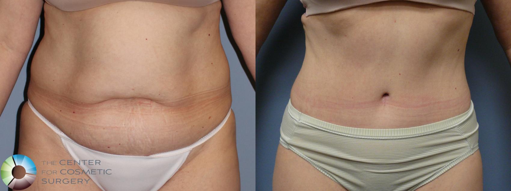 Before & After Tummy Tuck Case 11700 Front in Denver and Colorado Springs, CO