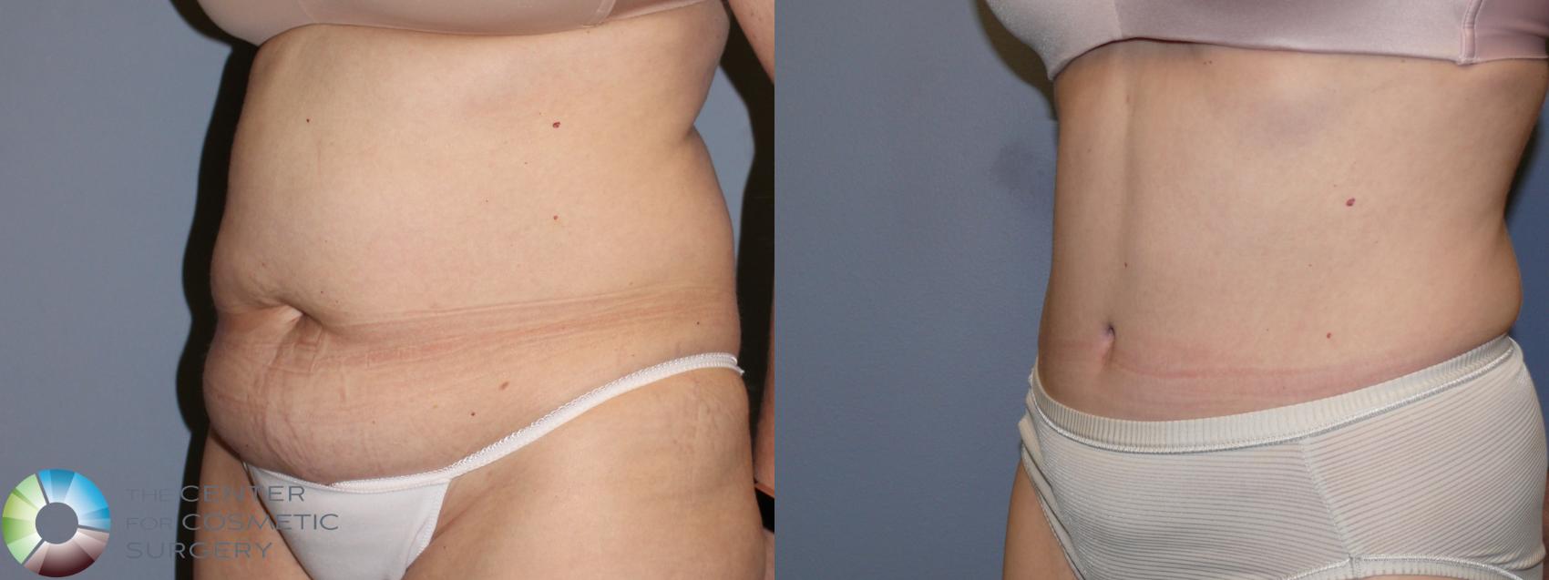 Before & After Tummy Tuck Case 11700 Left Oblique in Denver and Colorado Springs, CO