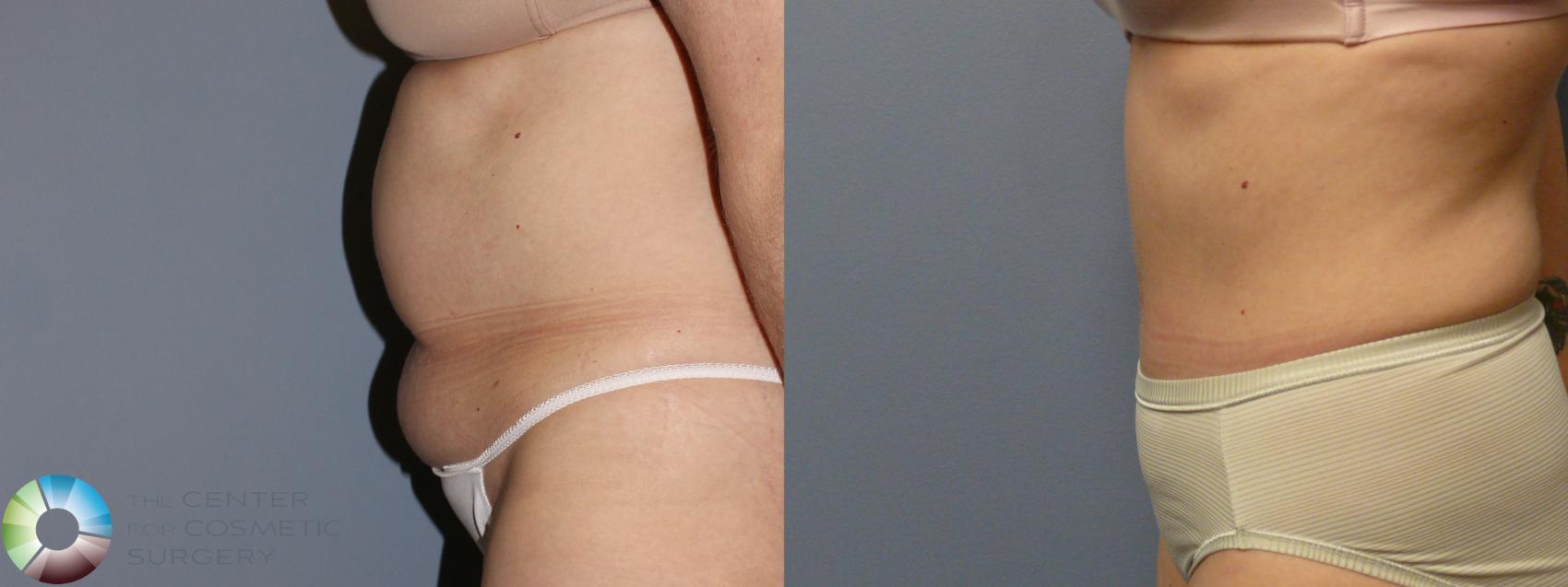 Before & After Tummy Tuck Case 11700 Left Side in Denver and Colorado Springs, CO