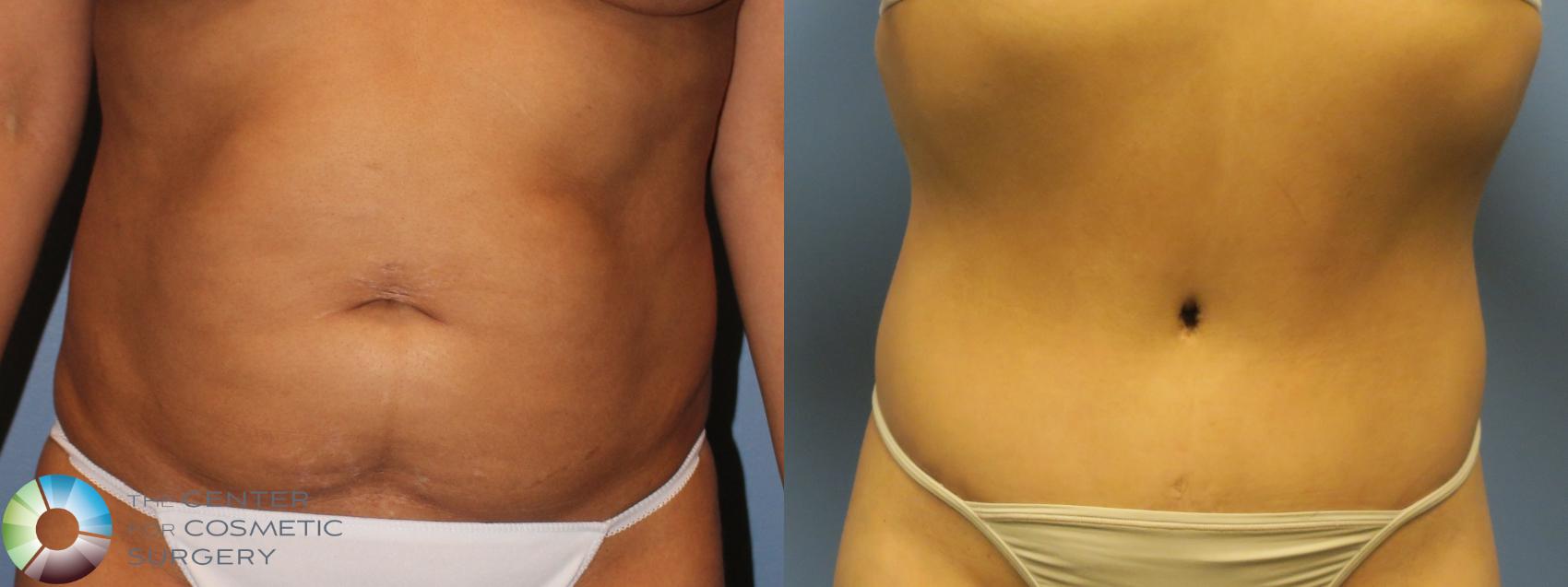 Before & After Tummy Tuck Case 11761 Front in Denver and Colorado Springs, CO