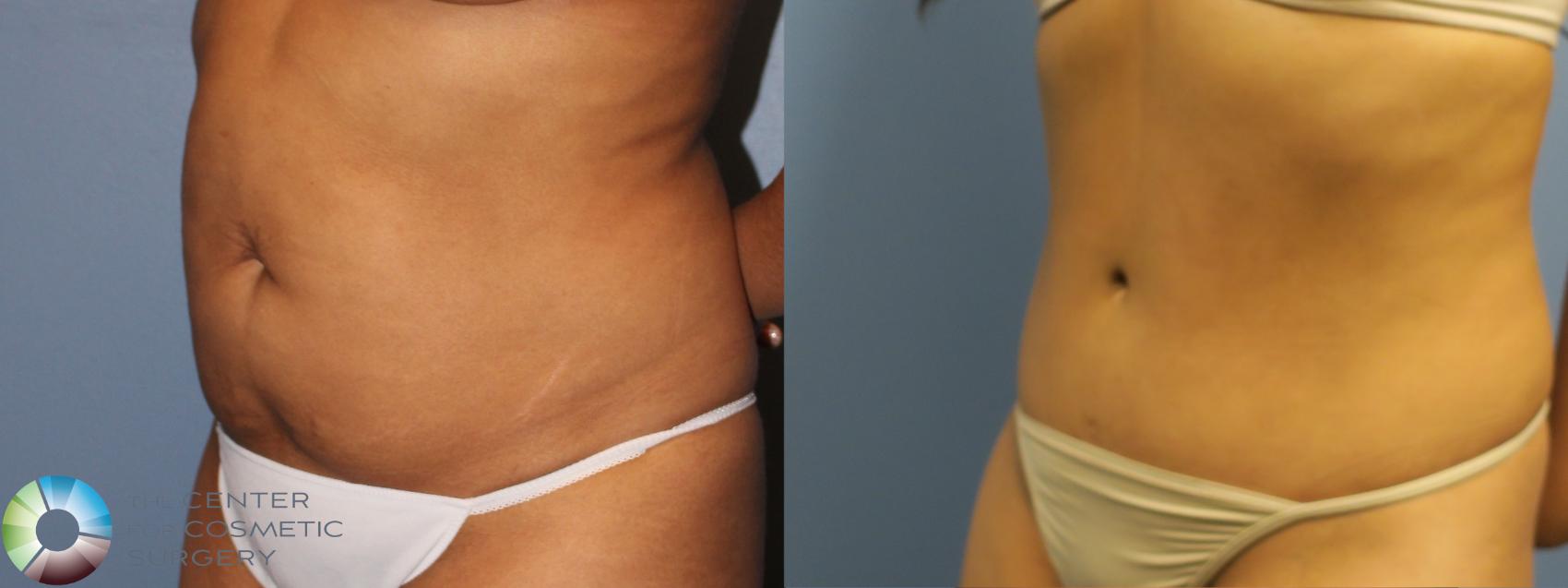 Before & After Tummy Tuck Case 11761 Left Oblique in Denver and Colorado Springs, CO