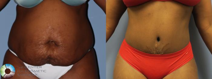Before & After Tummy Tuck Case 11762 Front in Denver and Colorado Springs, CO