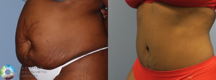 Before & After Tummy Tuck Case 11762 Left Oblique in Denver and Colorado Springs, CO