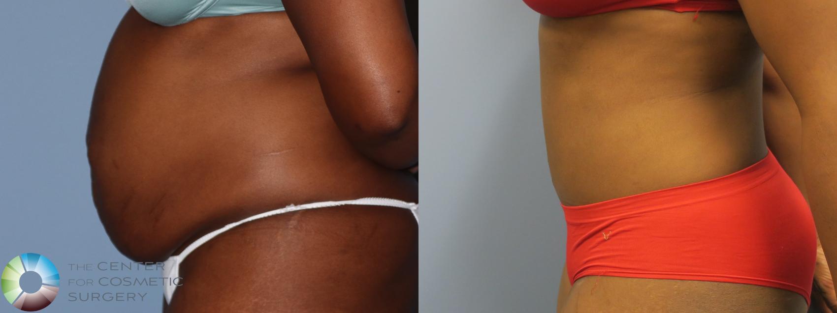 Before & After Tummy Tuck Case 11762 Left Side in Denver and Colorado Springs, CO