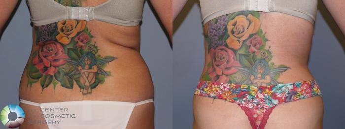 Before & After Tummy Tuck Case 11767 Back in Denver and Colorado Springs, CO
