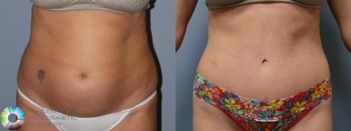 Before & After Tummy Tuck Case 11767 Front in Denver and Colorado Springs, CO