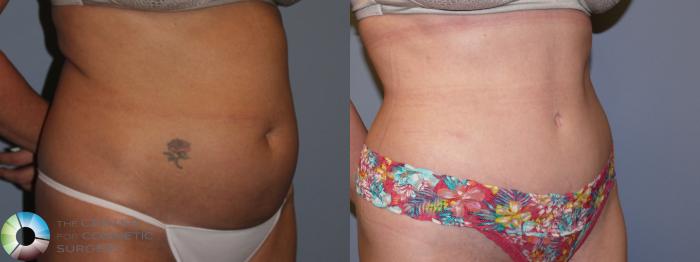 Before & After Tummy Tuck Case 11767 Right Oblique in Denver and Colorado Springs, CO