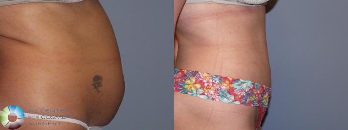Before & After Tummy Tuck Case 11767 Right Side in Denver and Colorado Springs, CO