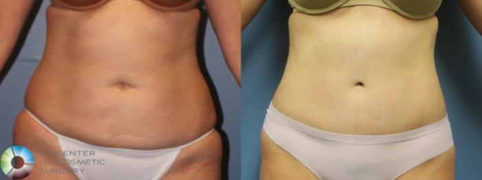 Before & After Tummy Tuck Case 11768 Front in Denver, CO