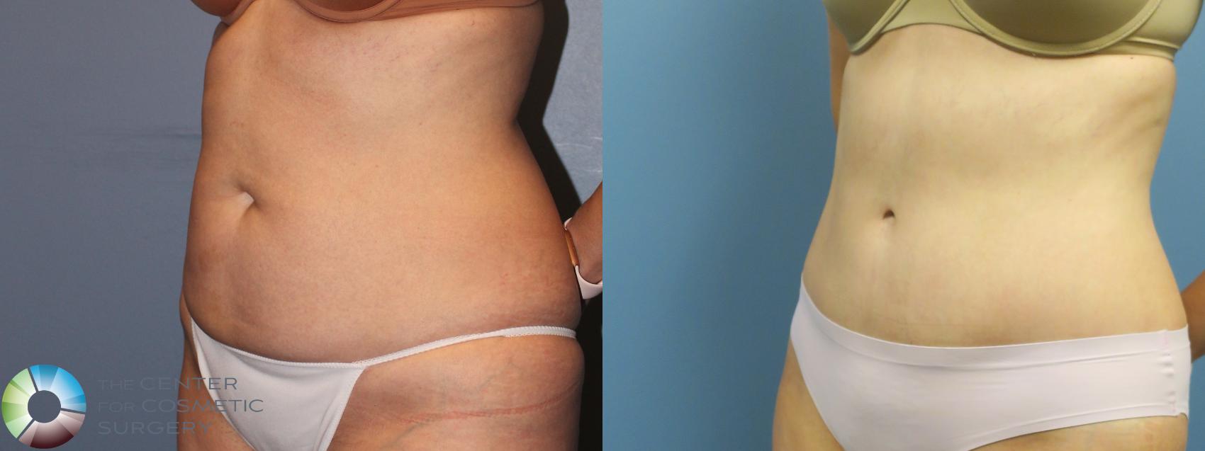 Before & After Tummy Tuck Case 11768 Left Oblique in Denver and Colorado Springs, CO