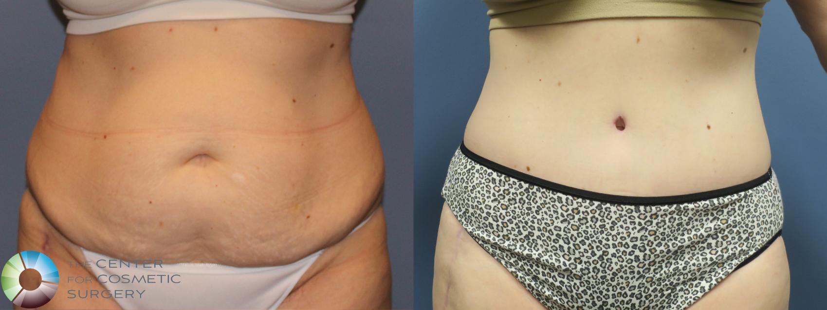 Before & After Tummy Tuck Case 11769 Front in Denver and Colorado Springs, CO