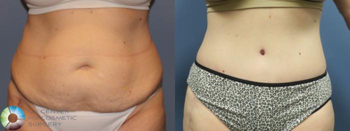 Before & After Tummy Tuck Case 11769 Front in Denver, CO