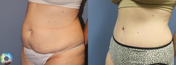 Before & After Tummy Tuck Case 11769 Left Oblique in Denver and Colorado Springs, CO