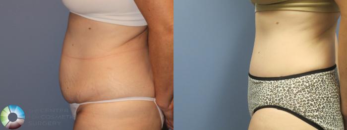 Before & After Tummy Tuck Case 11769 Left Side in Denver and Colorado Springs, CO