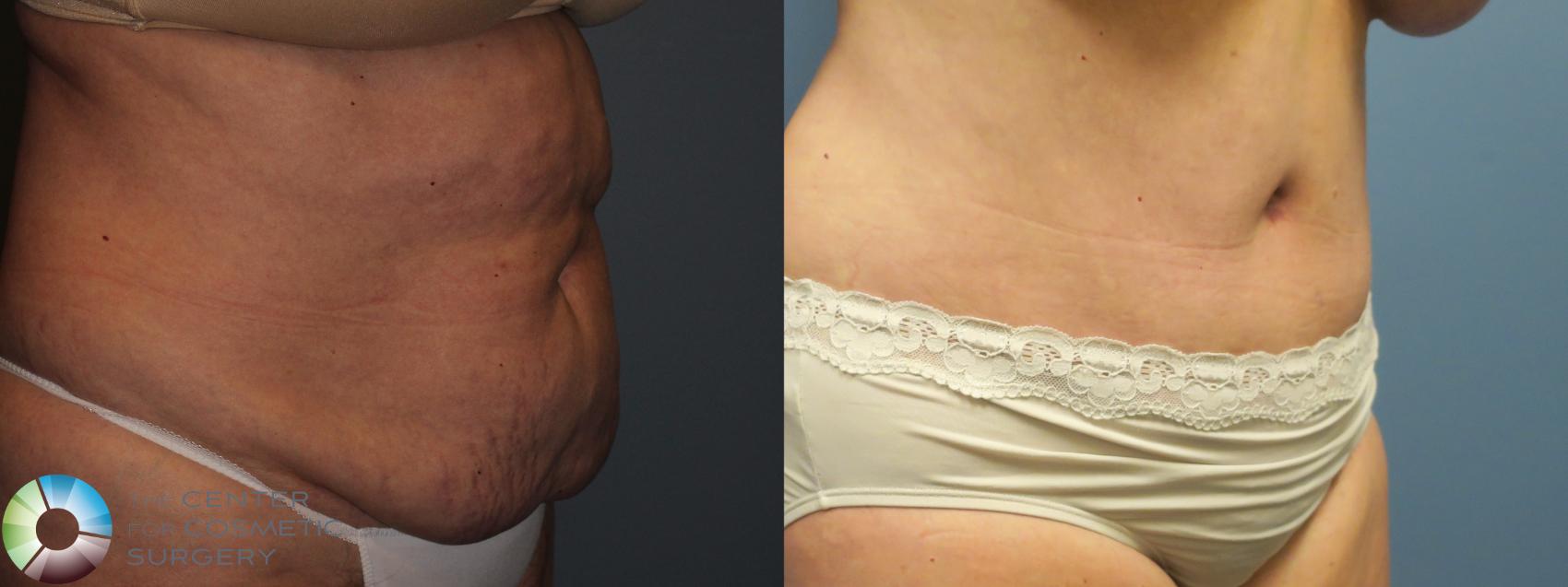 Before & After Tummy Tuck Case 11770 Right Oblique in Denver and Colorado Springs, CO