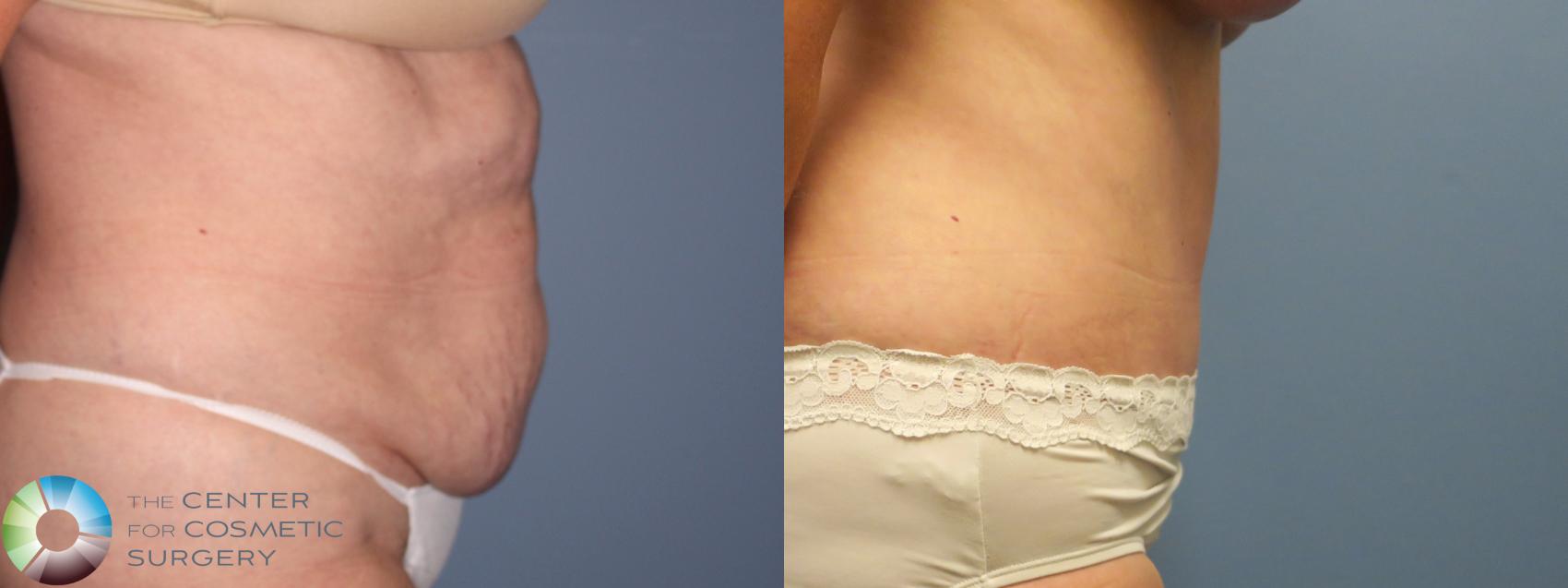 Before & After Tummy Tuck Case 11770 Right Side in Denver and Colorado Springs, CO