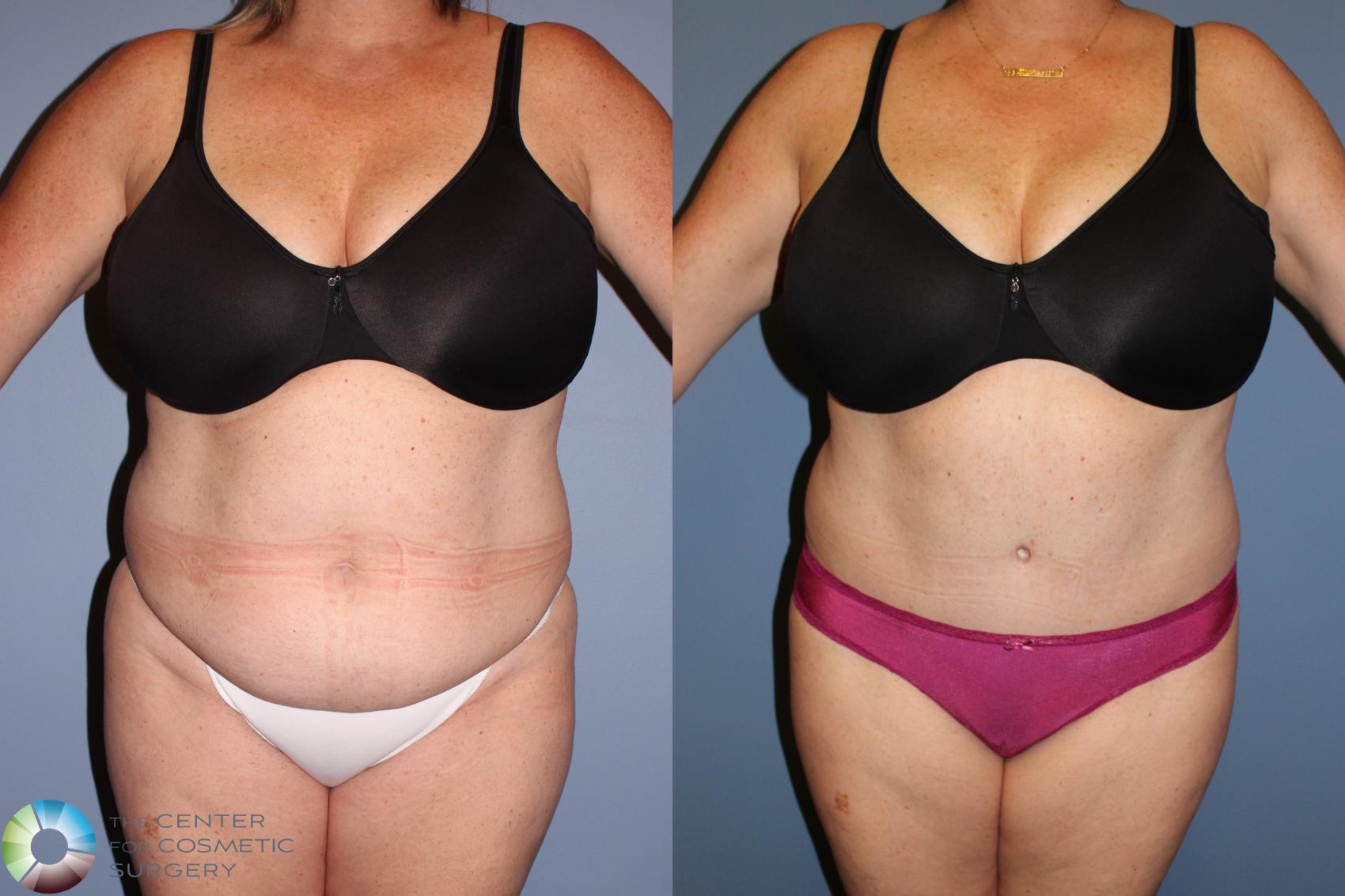 Before & After Tummy Tuck Case 11771 Front in Denver and Colorado Springs, CO