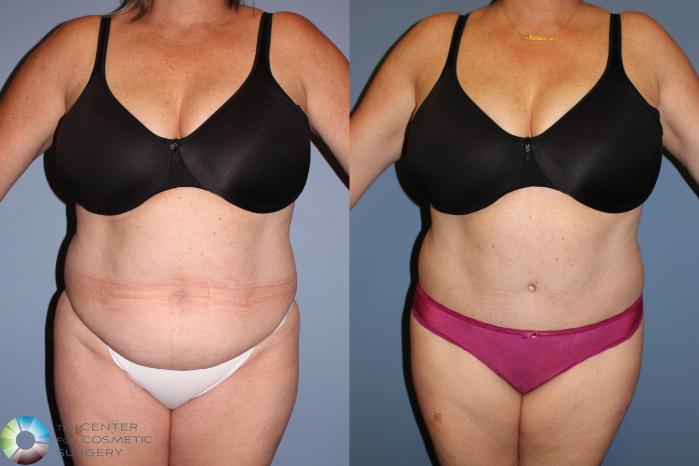Before & After Tummy Tuck Case 11771 Front View in Golden, CO