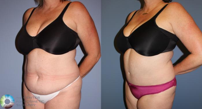Before & After Tummy Tuck Case 11771 Left Oblique View in Golden, CO
